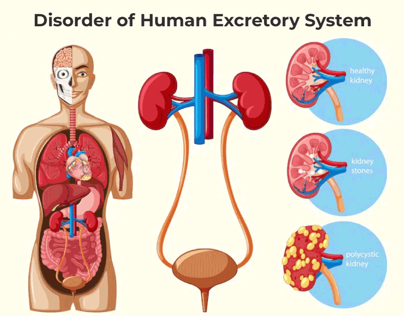 Disorder of Human Excretory System